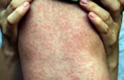 Thumbnail for article : Latest Measles Statistics Published